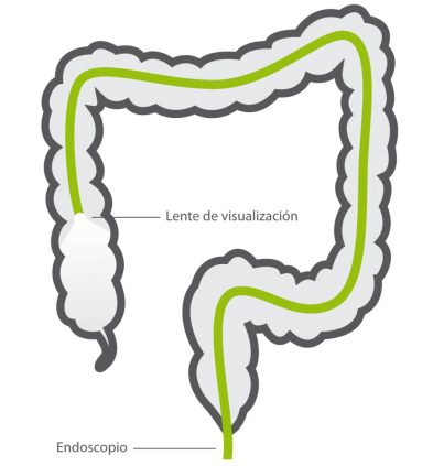 Exploración de todo el tubo digestivo bajo (ano, recto, sigma, resto de colon hasta ciego e inicio del íleon terminal) mediante un endoscopio que es introducido a través del ano del paciente.