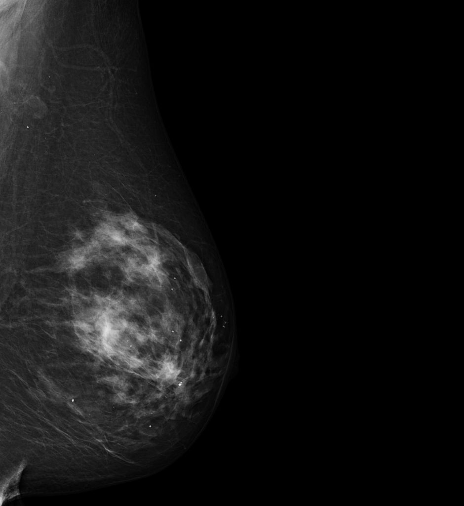 Mamografía 