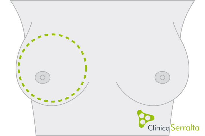 Reconstrucción mamaria. Clínica Serralta