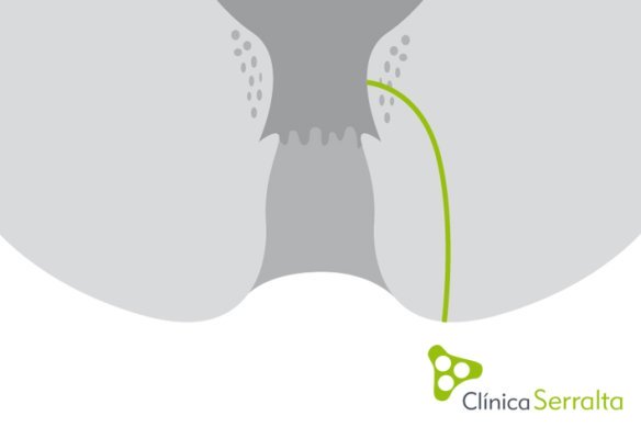 Fístula de ano. Clínica Serralta