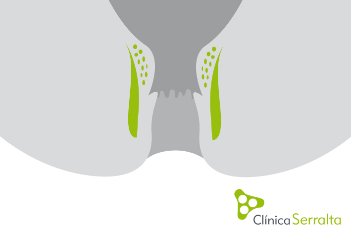 Hemorroidectomía. Clínica Serralta