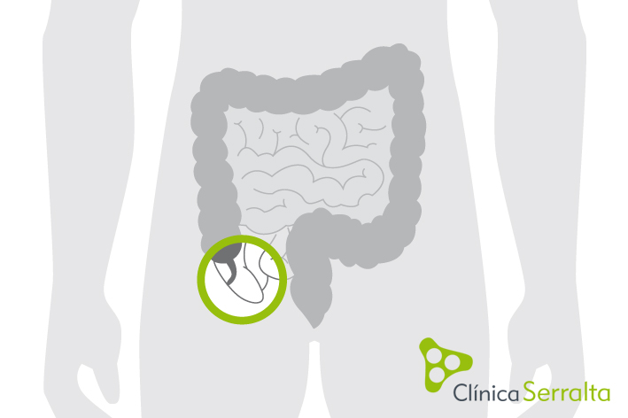 Hernia inguinal. Clínica Serralta