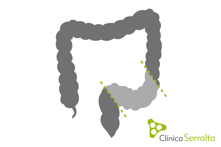 Colectomía subtotal. Clínica Serralta