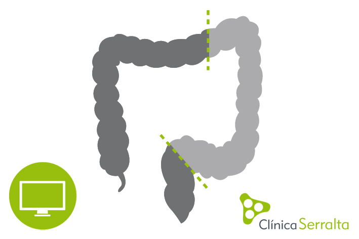 Hemicolectomía por laparoscopia. Clínica Serralta