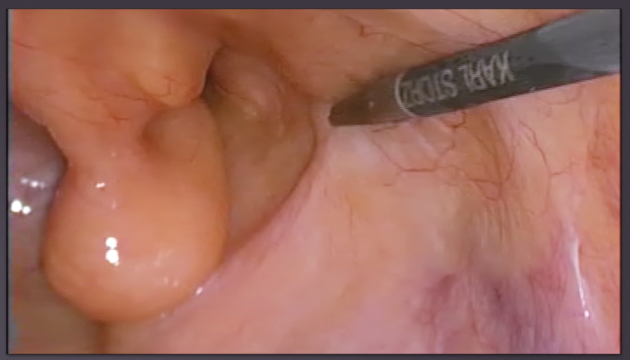Perdida de peso 5 kg operacion hernia de hiato precio