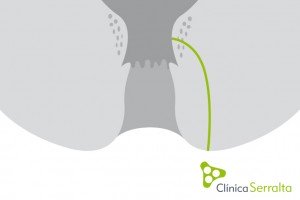 Fístula de ano. Clínica Serralta