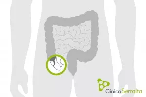 Hernia inguinal. Clínica Serralta