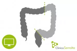 Hemicolectomía por laparoscopia. Clínica Serralta